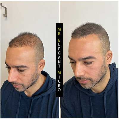 Scalp Micropigmentation For Men Thinning Hair