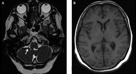 Trigeminal Nerve Curse Mri