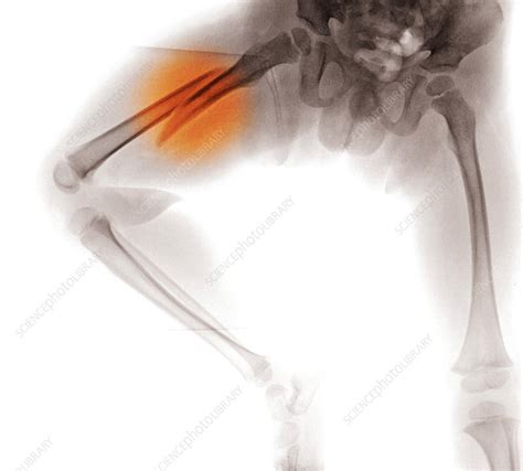 Femur Fracture, X-ray - Stock Image - C027/2647 - Science Photo Library