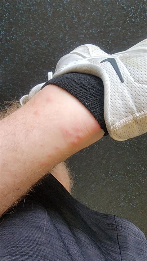 Are these mosquito bites? : r/MosquitoHating