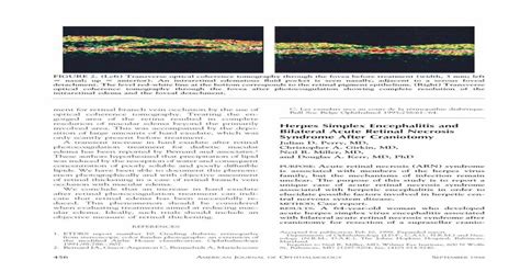 Herpes Simplex Encephalitis And Bilateral Acute Retinal Necrosis