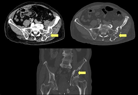 Figure 7 From Lesions On Pelvic Bones Spectrum And Radiologic Findings