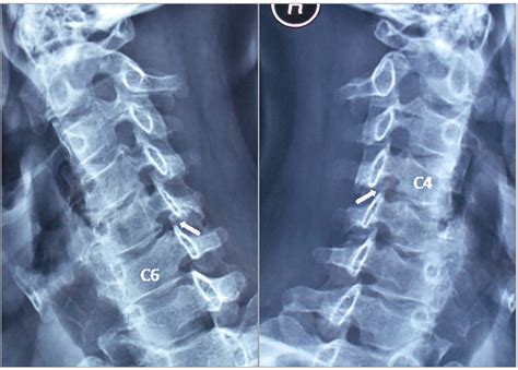 Cervical Radiculopathy Alleviating By Manipulative Correction Of