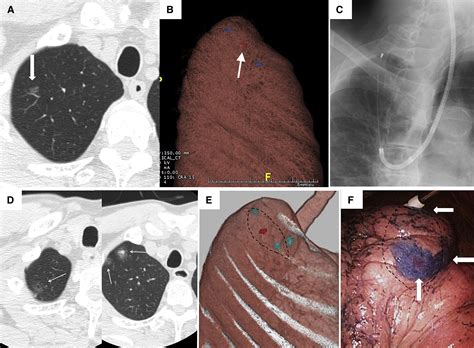 Use Of Virtual Assisted Lung Mapping Val Map A Bronchoscopic