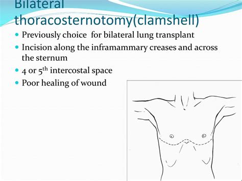 Clamshell Thoracotomy