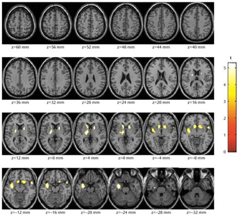 Crystal Meth Brain Effects