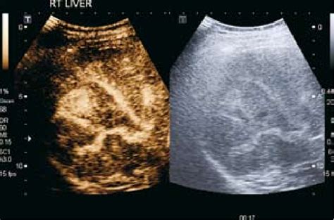 Hepatic Metastases Ceus Obtained In The Arterial Phase S Following