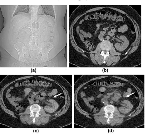 Figure From Virtual Unenhanced Ct Images Acquired From Dual Energy Ct