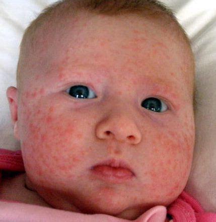 Baby Acne – Meaning, What Causes, Symptoms, Pictures, Types and How to ...