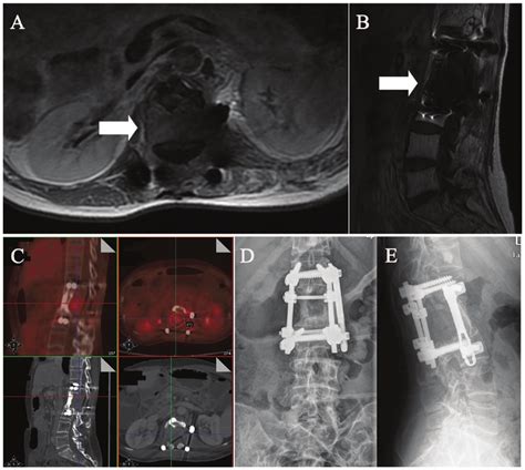 Pre And Post Operative Radiographic Images Of The L Metastatic