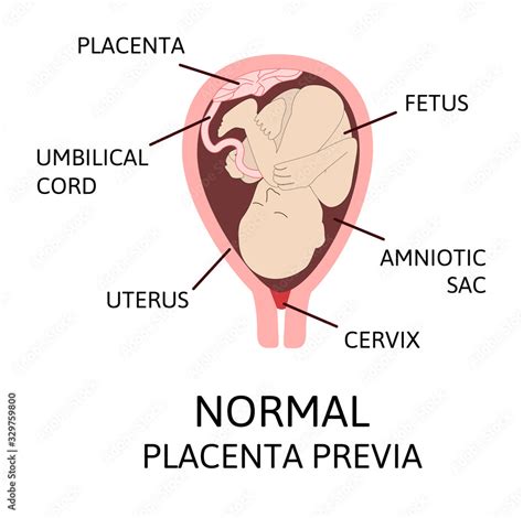 Different Placental Locations During Pregnancy Major And Normal