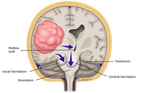 Neoplasms Of The Central Nervous System Flashcards Quizlet