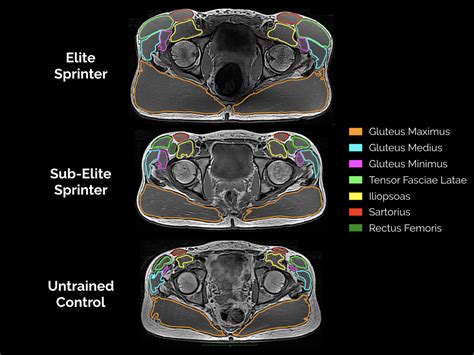 Mri Plantar Foot Anatomy Muscles