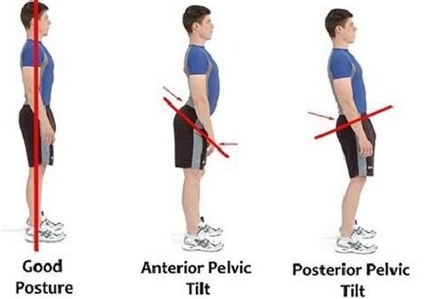 Anterior Vs Posterior Pelvic Tilt