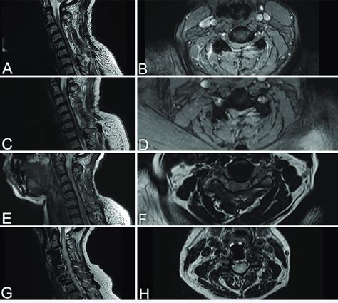 Postoperative Cervical T2 Weighted Sagittal And Axial Mri Scans For