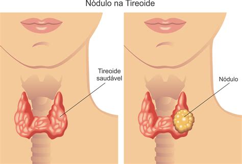 N Dulo Na Tireoide Sintomas E Caracter Sticas