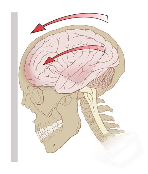 Pathophysiology Of The Nervous System Chapters Naxlex Nursing