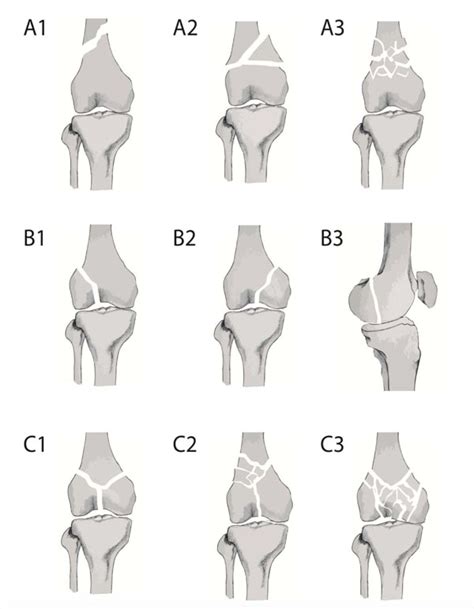 Femur Fracture Classification