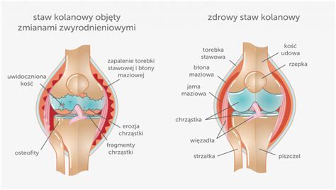 B L Kolana Rodzaje B Lu Przyczyny I Leczenie Biznes Z Widokiem Na