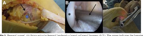 Figure 2 From Combined Anterior And Anterolateral Stabilization Of The