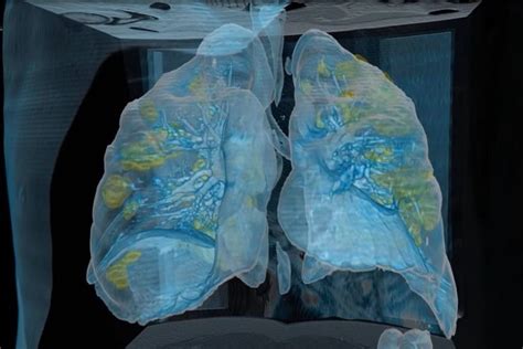 El impresionante video que muestra el daño pulmonar de un paciente con