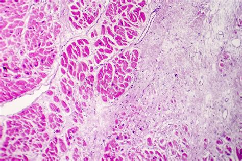 Acute Myocardial Infarction Histology Of Heart Tissue Light