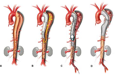 Controlled… The American Association For Thoracic Surgery Aats