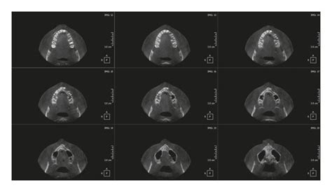 Axial View Of Cone Beam Computerized Tomography Showing The Healing At