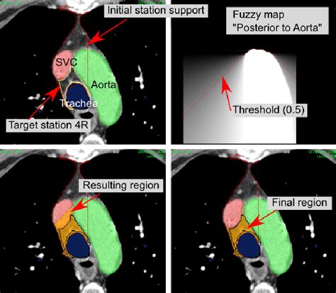 Figure From Investigating Mediastinal Lymph Node Stations