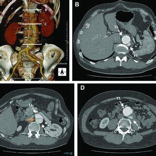 A, Three-dimensional reconstruction of preoperative computed tomography ... 
