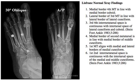 Lisfranc fracture-dislocation S93.326A 838.03 | eORIF