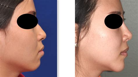 Rhinoplasty And Chin Augmentation Result Dr Barry Eppley Indianapolis