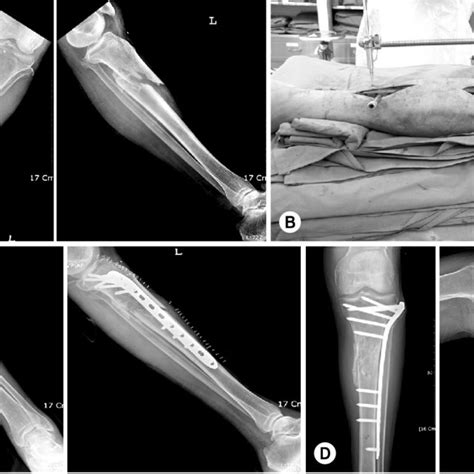 Pdf Proximal Tibia Fracture Plating