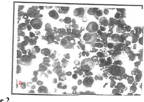 Figure 1 from Various presentations of multiple myeloma MRI review: A Case series | Semantic Scholar