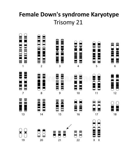 Down S Syndrome Karyotype Female Stock Vector Illustration Of