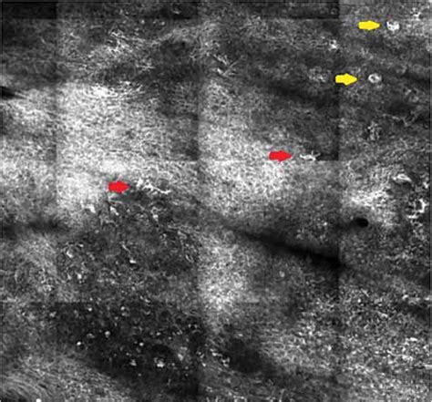 Scielo Brasil Reflectance Confocal Microscopy Of Cutaneous Melanoma