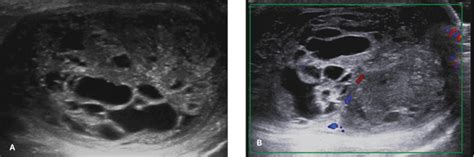 Testicular Teratoma Ultrasound