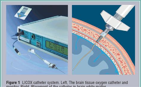 Figure From Usefulness In Critical Care Brain Tissue Oxygen