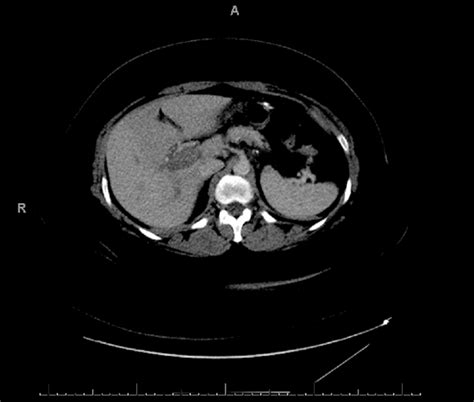 Superior Mesenteric Vein Thrombosis