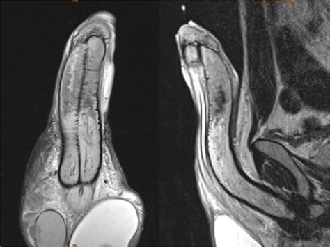 Magnetic Resonance Imaging Confirming Initial Absence Of Vascularity In