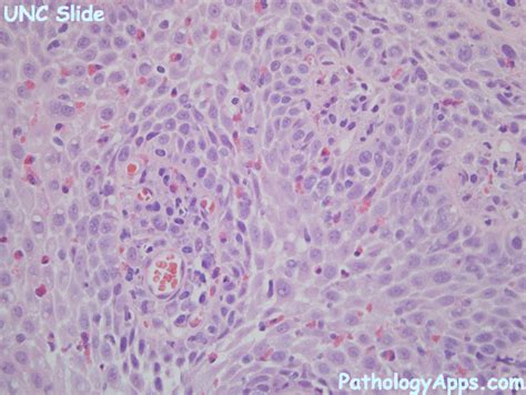 Eosinophilic Esophagitis Pathology