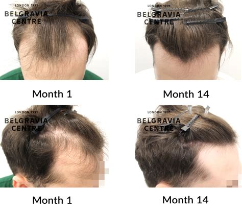 Hair Loss Success Story Very Pleased With The Results And Service