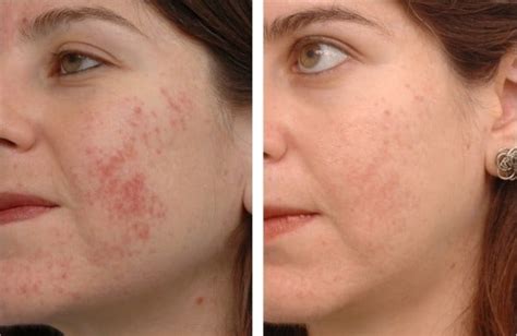 Remove Acne Scars Sydney 1 Where To And How Safe Effective