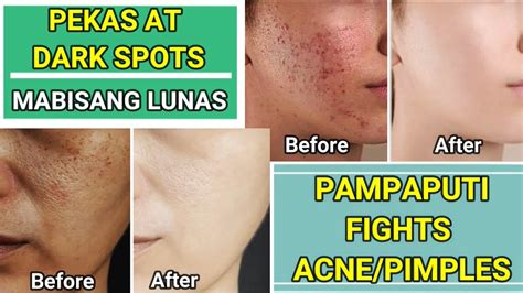 Mabisang Lunas Sa Dark Spots Pekas Or Melasma Fights Acnepimples