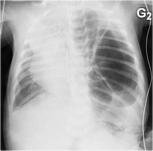 Cystic Pleuropulmonary Blastoma Type I Case 1 Conventional