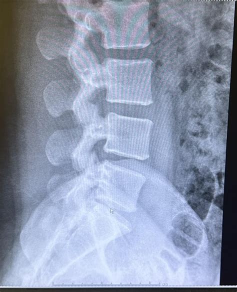 physical therapy tips? : r/Spondylolisthesis