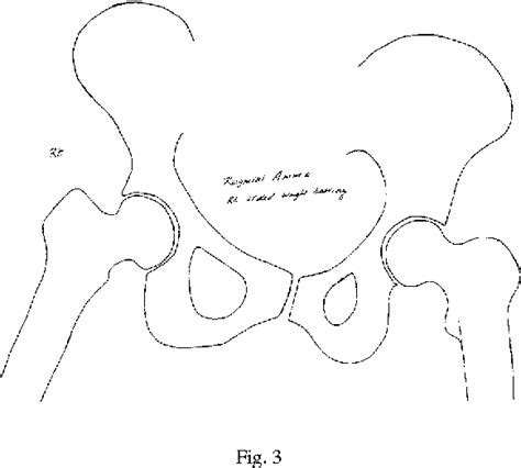 Figure 1 from Can Trendelenburg's sign be positive if the hip is normal? | Semantic Scholar