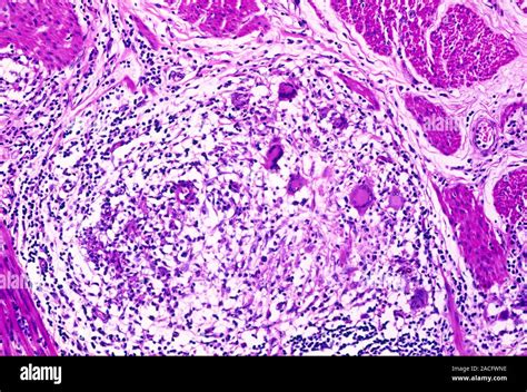 Crohn S Disease Light Micrograph Of A Section Through A Large Intestine Affected By Crohn S