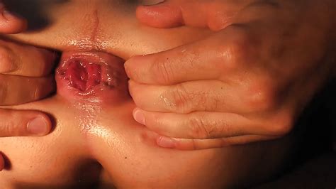 Big Assfist Giant Gape Spread My Asshole Part Nude Pics Xhamster
