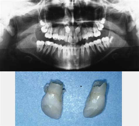 Ectopic Displaced Teeth